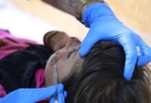 اللشمانيا في حلب.. أكثر من 13 ألف إصابة وحملة واسعة للمكافحة 2 اللشمانيا في حلب.. أكثر من 13 ألف إصابة وحملة واسعة للمكافحة