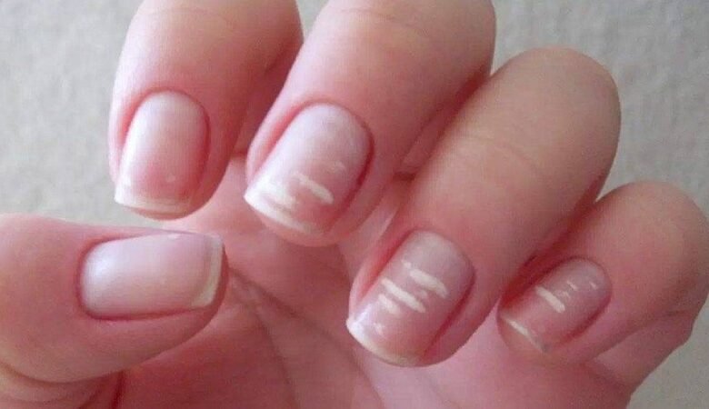 ماذا تخبرك أظافرك عن صحتك؟