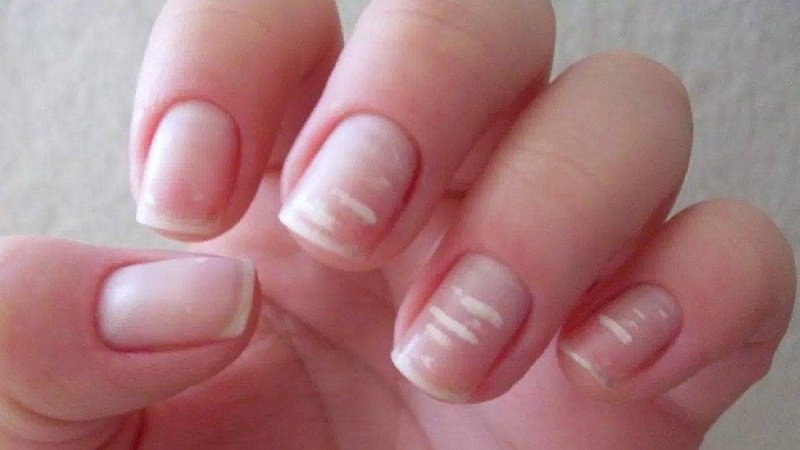 ماذا تخبرك أظافرك عن صحتك؟ 2 ماذا تخبرك أظافرك عن صحتك؟