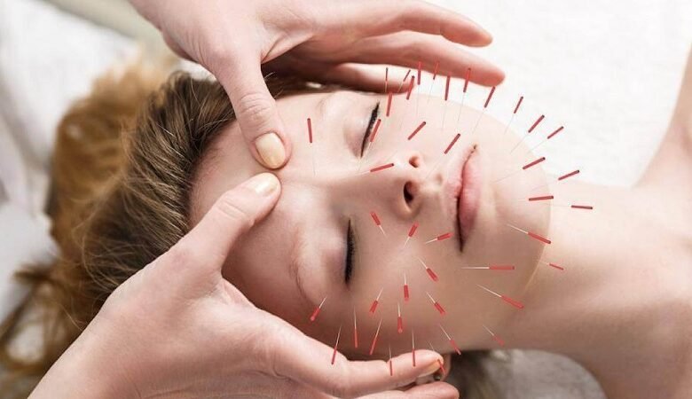 الوخز بالإبر علاج قديم.. لماذا لم يفقد مكانته؟ 1 الوخز بالإبر علاج قديم.. لماذا لم يفقد مكانته؟