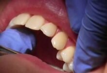 ما علاقة تنظيف الأسنان يومياً بصحة القلب والشرايين؟ 2 ما علاقة تنظيف الأسنان يومياً بصحة القلب والشرايين؟