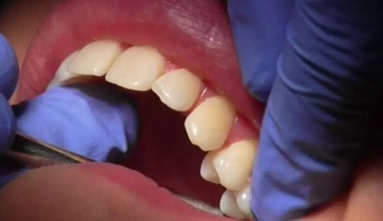 ما علاقة تنظيف الأسنان يومياً بصحة القلب والشرايين؟ 1 ما علاقة تنظيف الأسنان يومياً بصحة القلب والشرايين؟