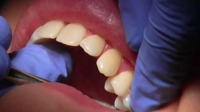 ما علاقة تنظيف الأسنان يومياً بصحة القلب والشرايين؟